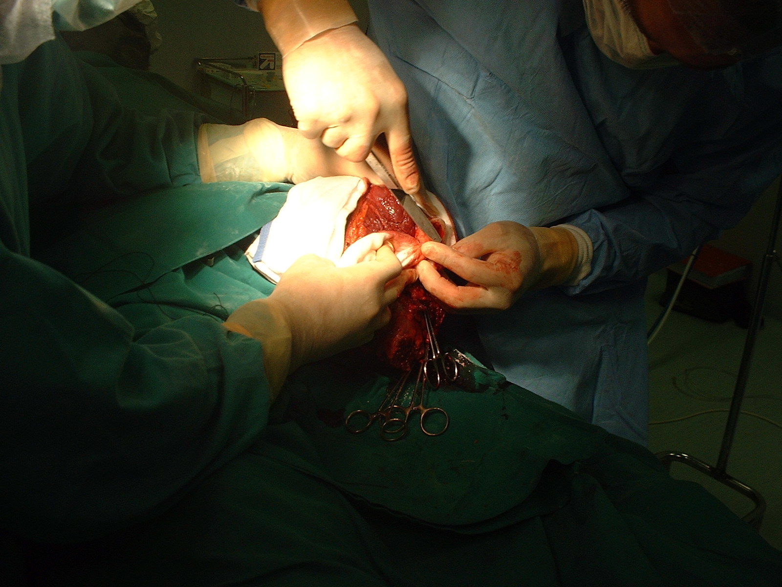 Operative photograph — Isilimela Hospital