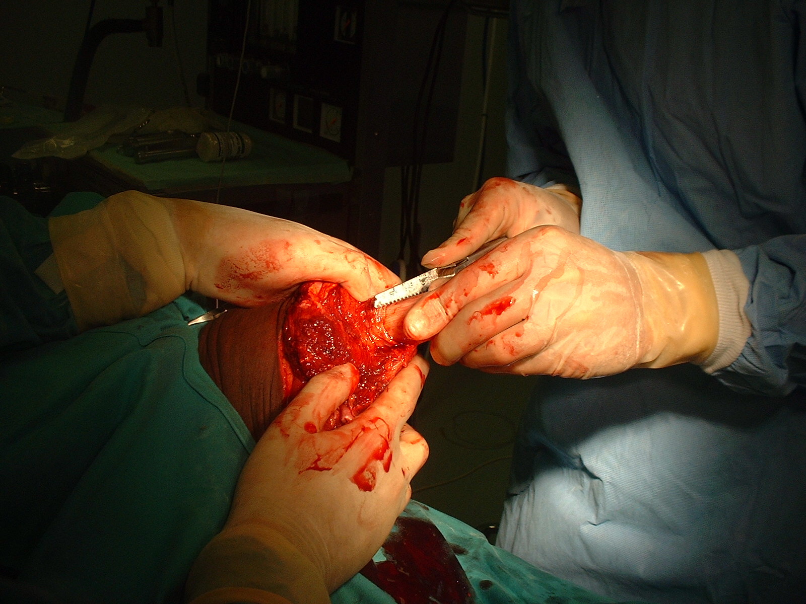 Operative photograph — femoral section with Leatherman