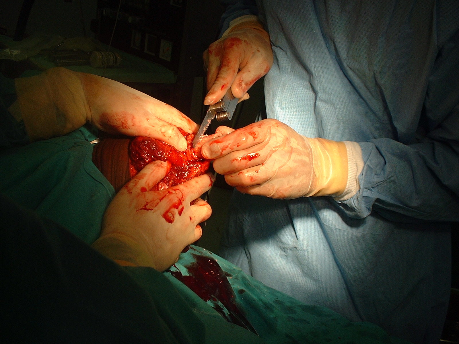 Operative photograph — above-knee amputation, Isilimela Hospital