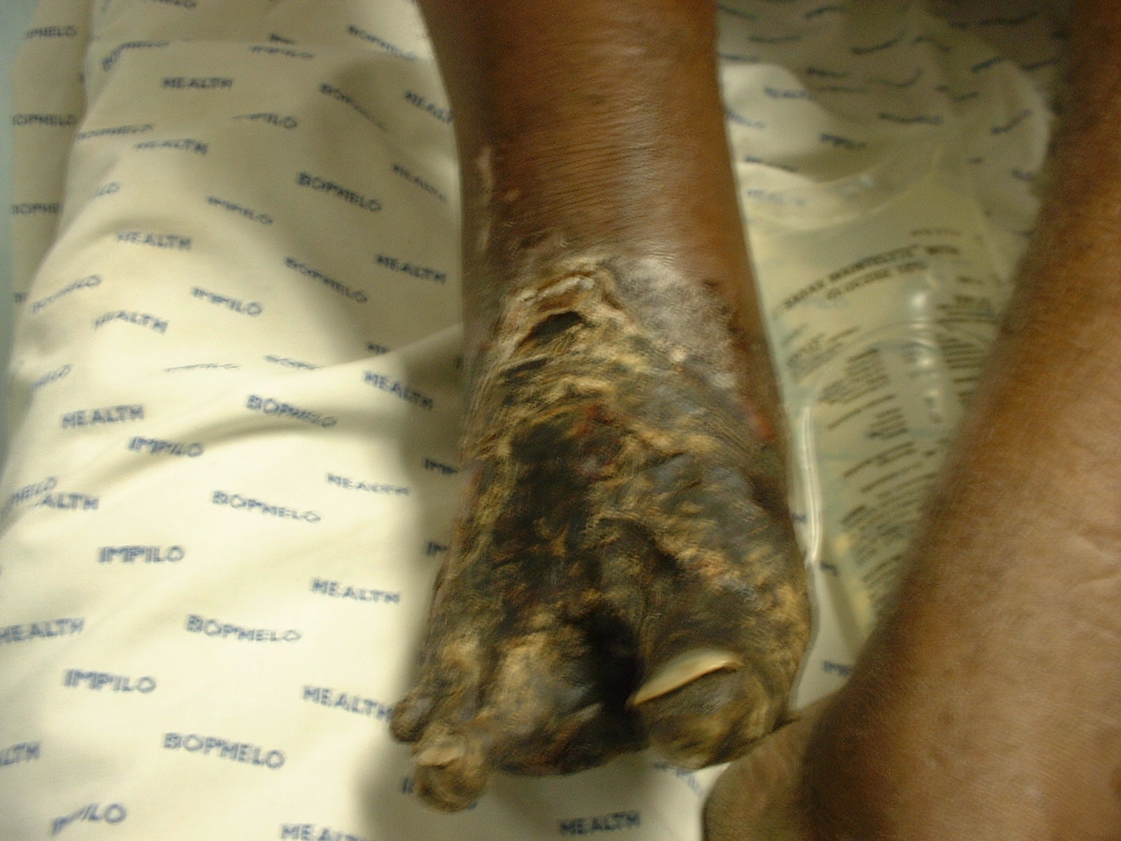 Dry gangrene of the foot — the reason amputation was necessary