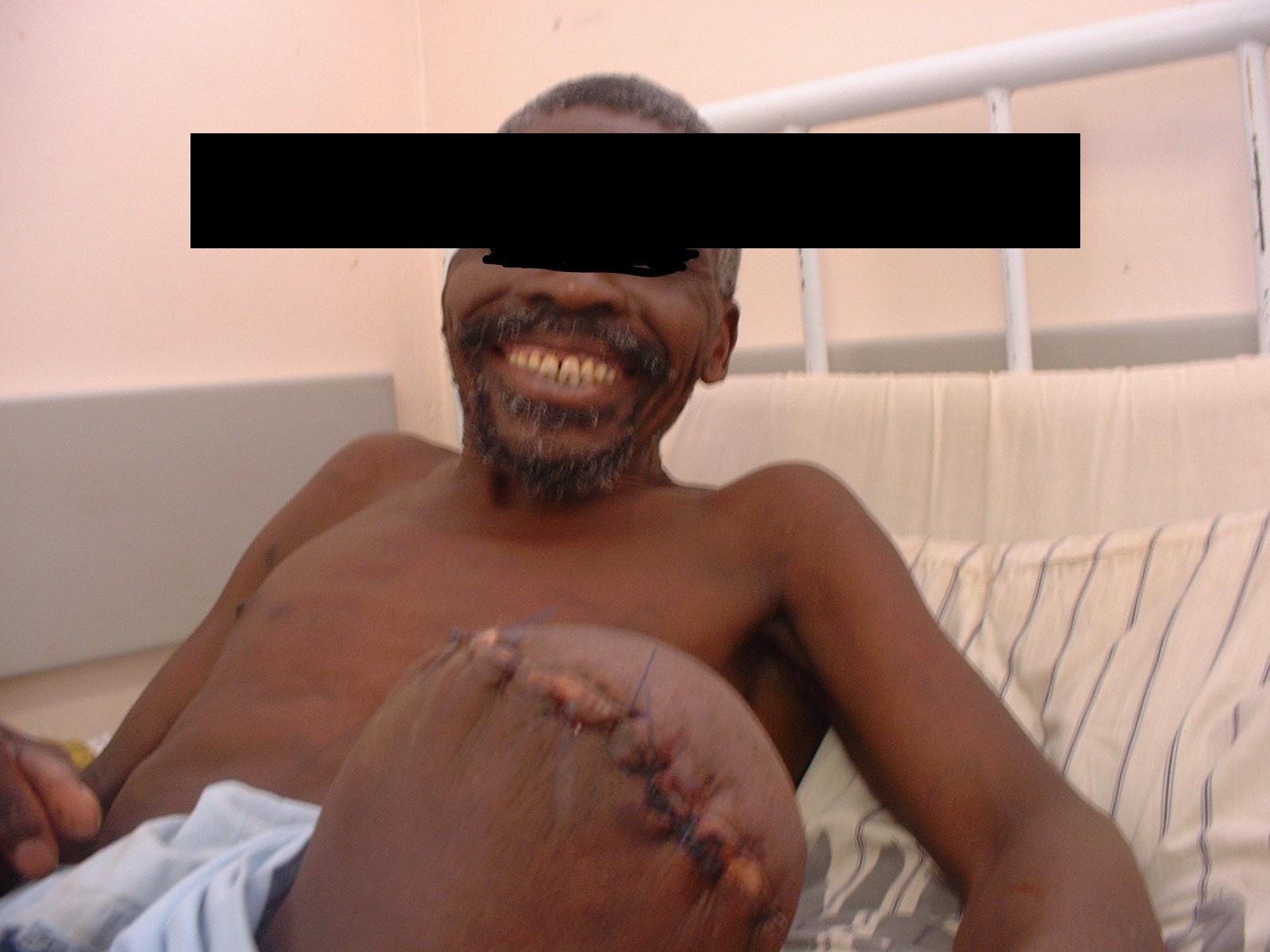 Tata later in recovery — smiling with healed stump