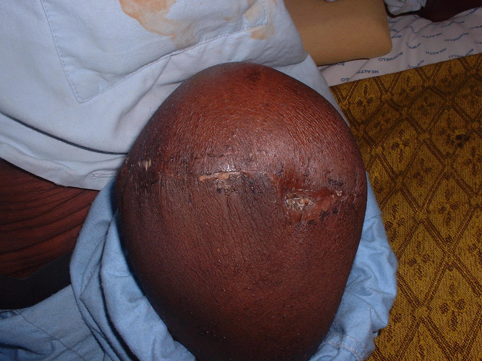 Healed stump — two days post-operative